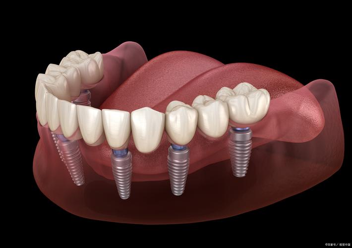 全口牙种牙哪里做好？靠谱医院和医生怎么选？-图2