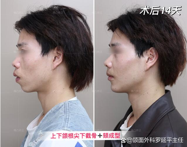 正颌手术前正畸很难看-图2