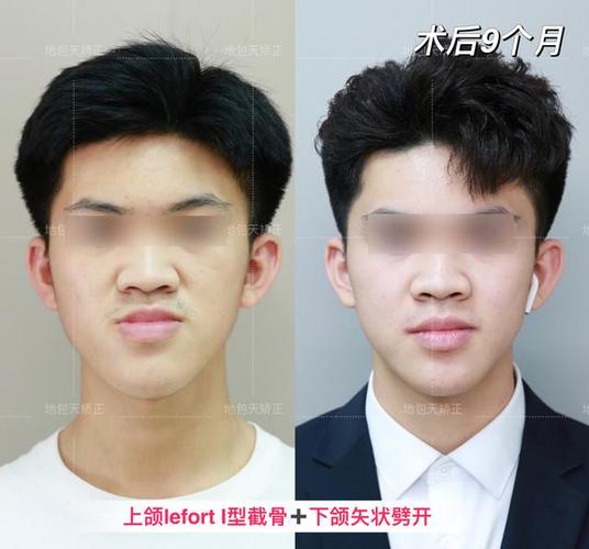 正颌手术前正畸很难看-图1