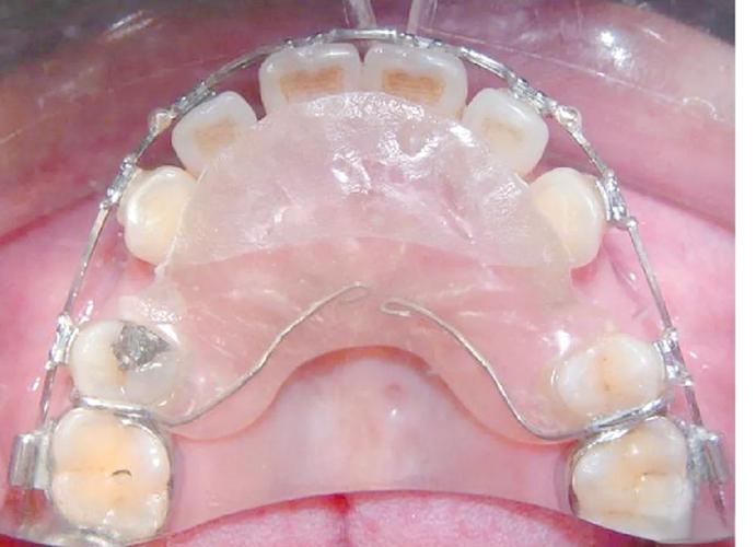 正畸活动式矫正器图片主要展示哪些佩戴效果与类型？-图1