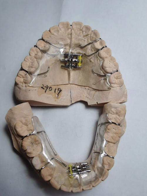 正畸活动式矫正器图片主要展示哪些佩戴效果与类型？-图3