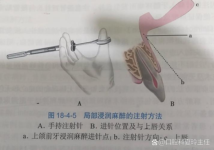 口腔局麻方法有几种？常见类型、适用范围及临床应用详解-图2
