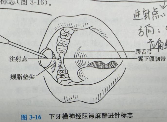拔牙常用局麻方法有哪些?如何确保麻醉效果与安全?-图1 拔牙常用局麻方法有哪些?如何确保麻醉效果与安全?-图1
