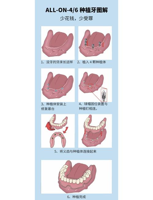 全口种植牙一般需要种几颗？-图1