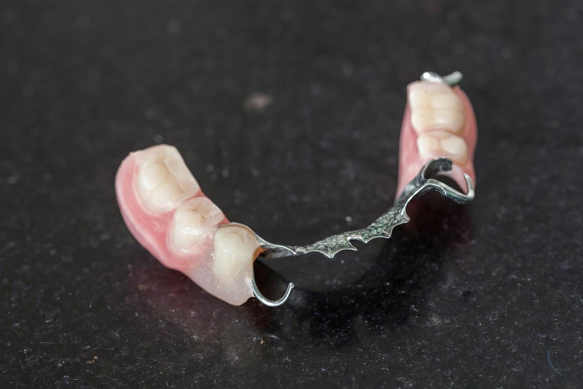 青岛假牙制作方法的具体步骤是怎样的？-图2