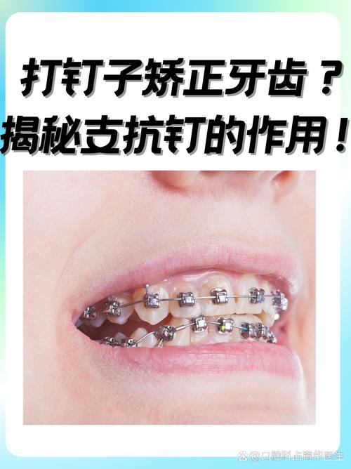 如何有效增加前牙支抗?实用方法有哪些?-图3 如何有效增加前牙支抗?实用方法有哪些?-图3