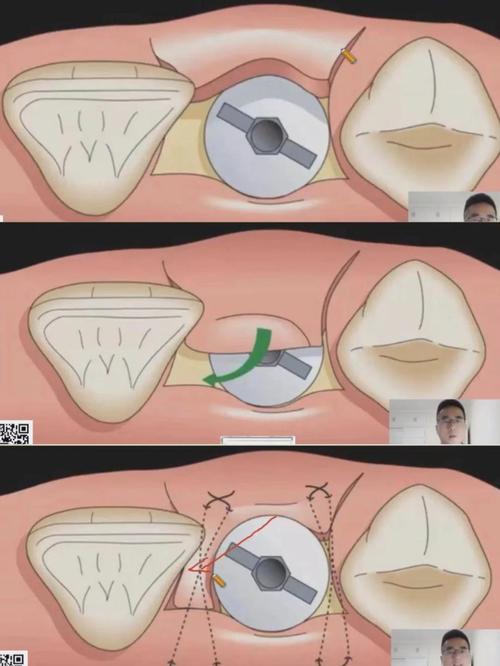 牙龈切口缝合方法有哪些关键步骤？-图1