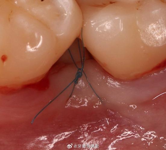 牙龈切口缝合方法有哪些关键步骤？-图2