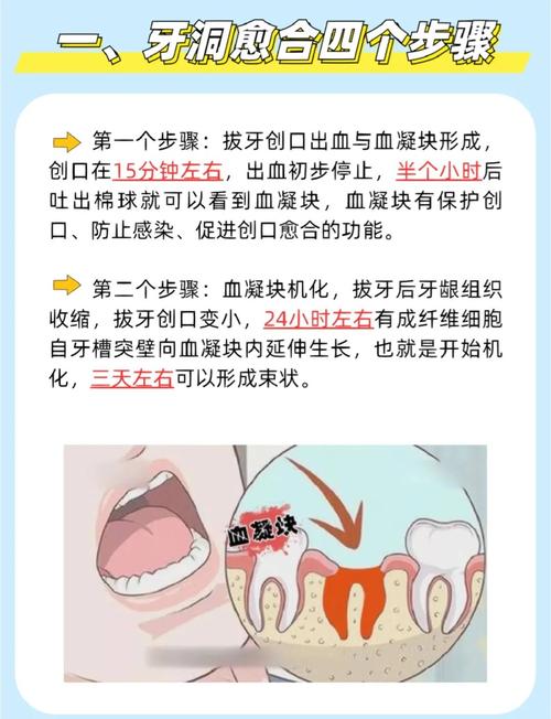 如何促进拔牙创口快速愈合?-图1 如何促进拔牙创口快速愈合?-图1