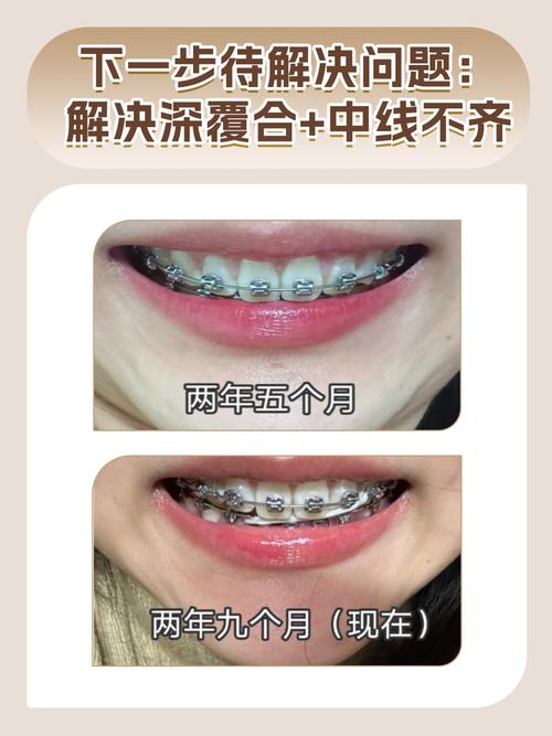 正畸戴牙套期间能正常进食吗？-图2