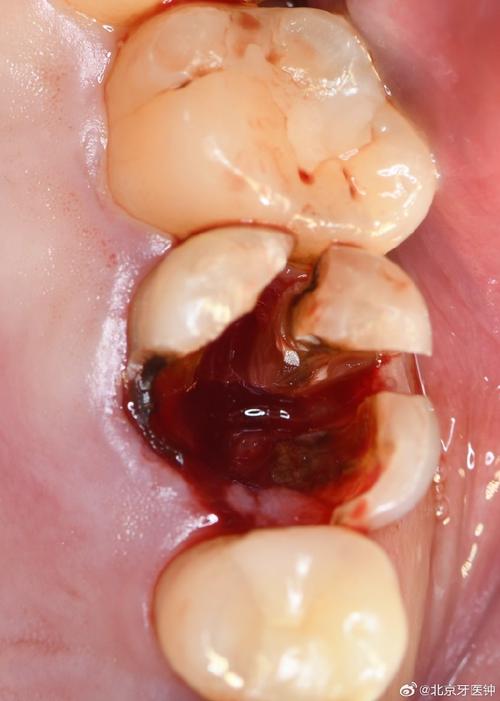 牙歪了必须拔牙吗?拔牙后一定要种牙吗?-图3 牙歪了必须拔牙吗?拔牙后一定要种牙吗?-图3