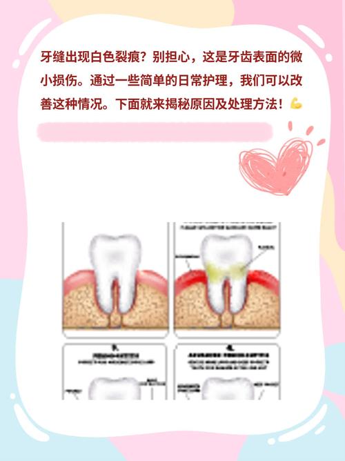 烂牙缝怎么处理?实用方法有哪些?-图1 烂牙缝怎么处理?实用方法有哪些?-图1