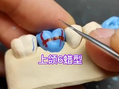 正畸术前模型取咬合蜡，对矫正效果有何关键作用？-图2