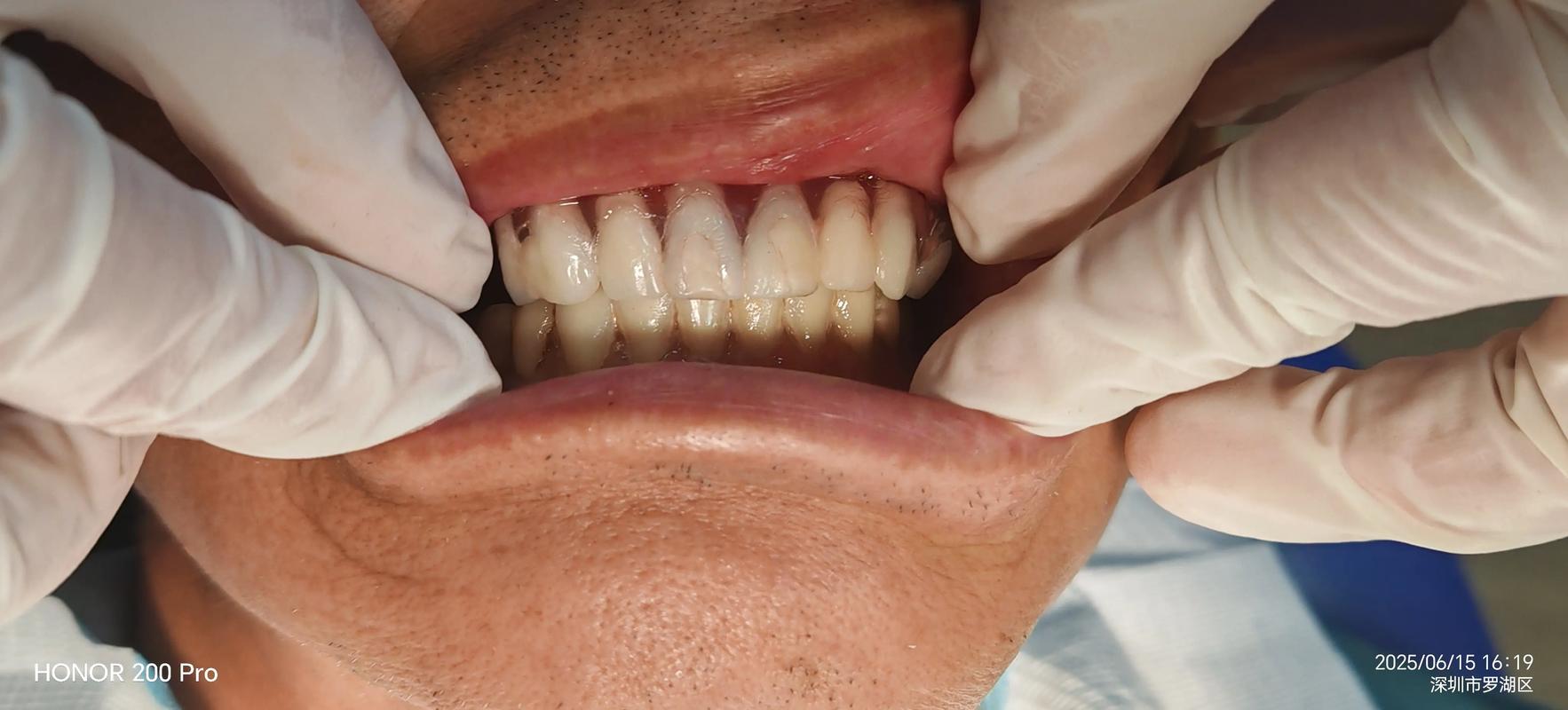 正畸术前模型取咬合蜡，对矫正效果有何关键作用？-图1