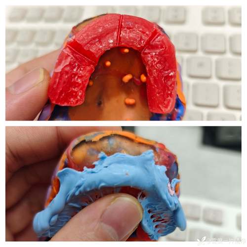 正畸术前模型取咬合蜡，对矫正效果有何关键作用？-图3