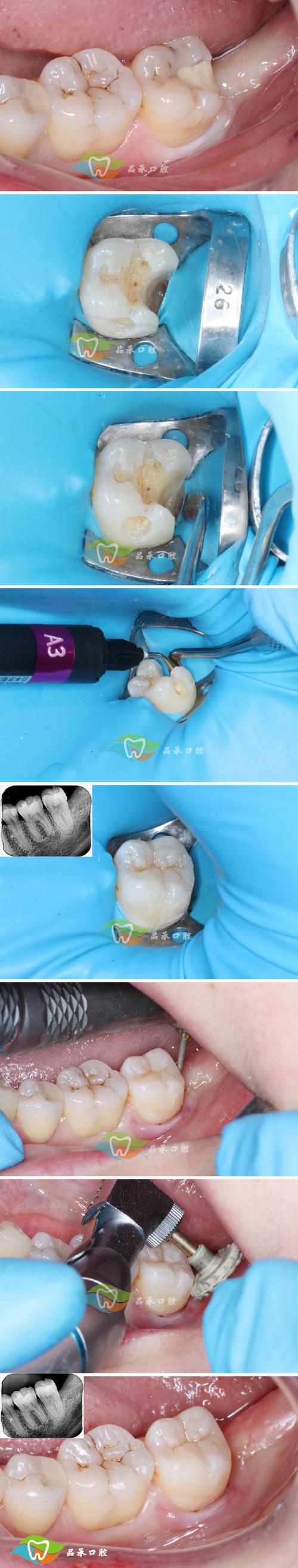 如何有效破坏牙齿菌膜？这些方法真的管用吗？有哪些具体步骤？-图2