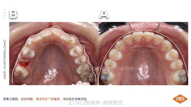龋齿很严重可以正畸么-图1 龋齿很严重可以正畸么-图1