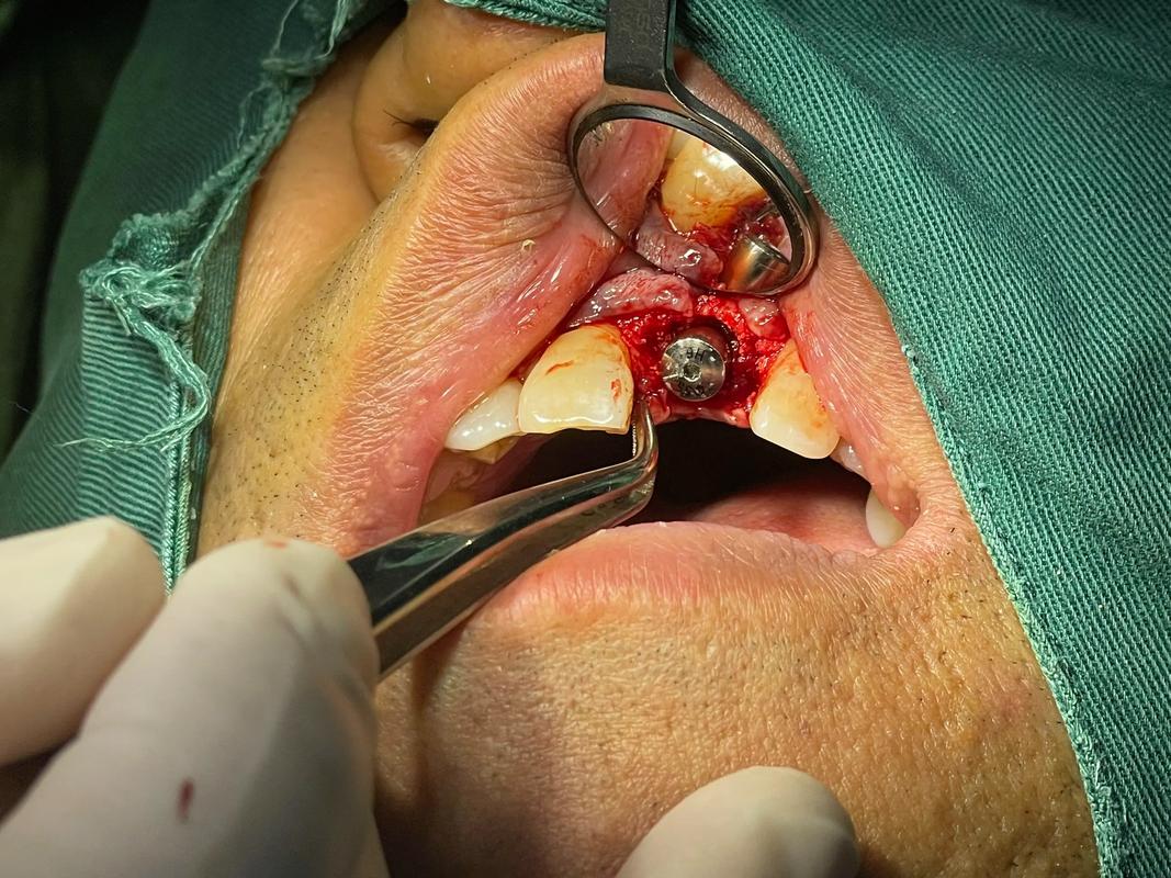 缺牙25年，种牙能恢复咀嚼功能吗？-图1