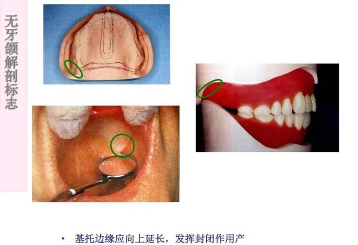 无牙颌口底封闭方法关键临床操作步骤与效果如何?-图1 无牙颌口底封闭方法关键临床操作步骤与效果如何?-图1