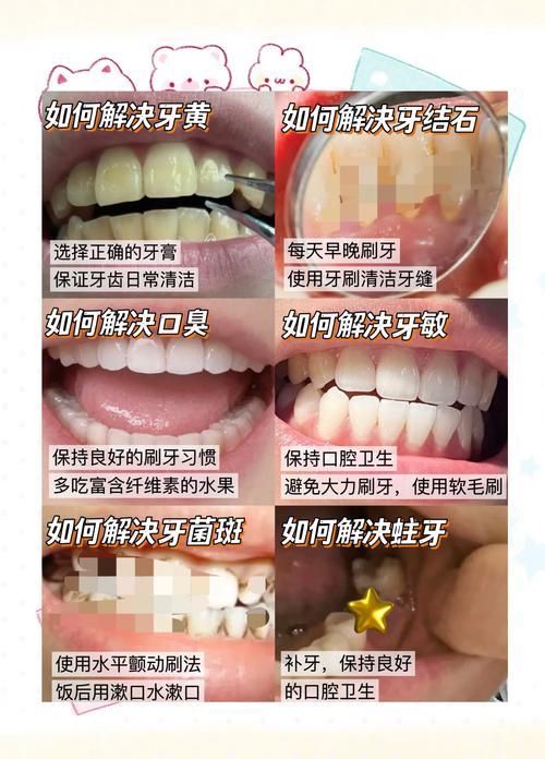 黄斑牙的最佳治疗方法是什么?如何选择安全有效的治疗方式?-图2 黄斑牙的最佳治疗方法是什么?如何选择安全有效的治疗方式?-图2