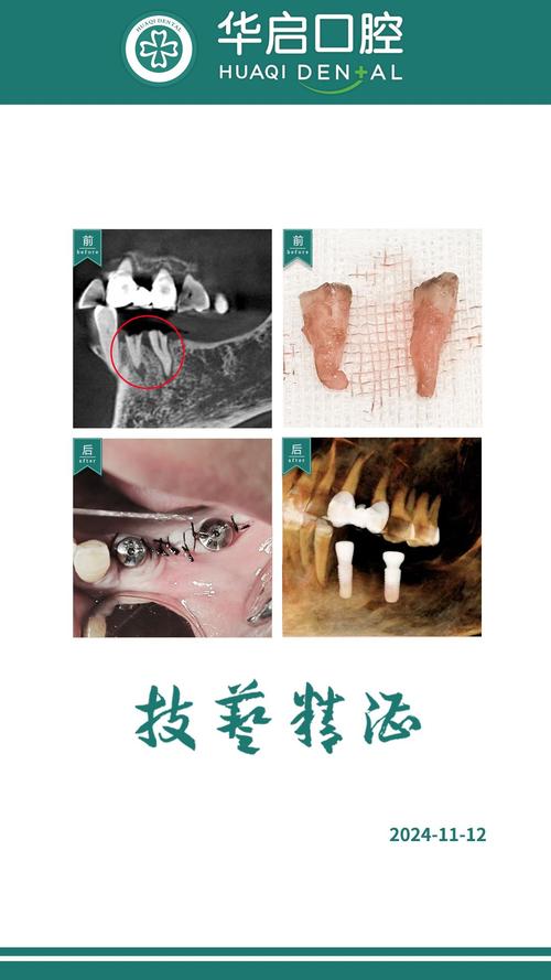 种牙为何要先拔牙?拔牙后种牙的必要步骤?-图3 种牙为何要先拔牙?拔牙后种牙的必要步骤?-图3