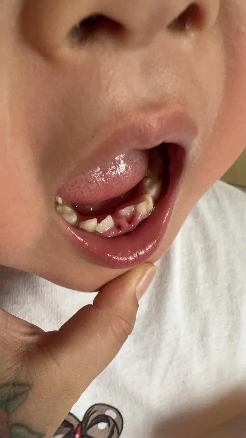 拔牙后长时间不种牙，对邻牙、牙槽骨及咬合功能有何影响？-图2