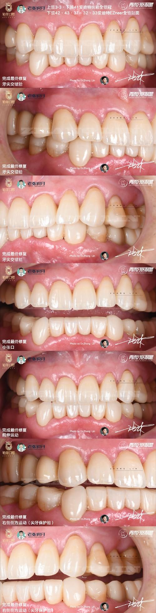 口腔咬合重建的方法有哪些？不同方法的适用情况及效果如何选择？-图2