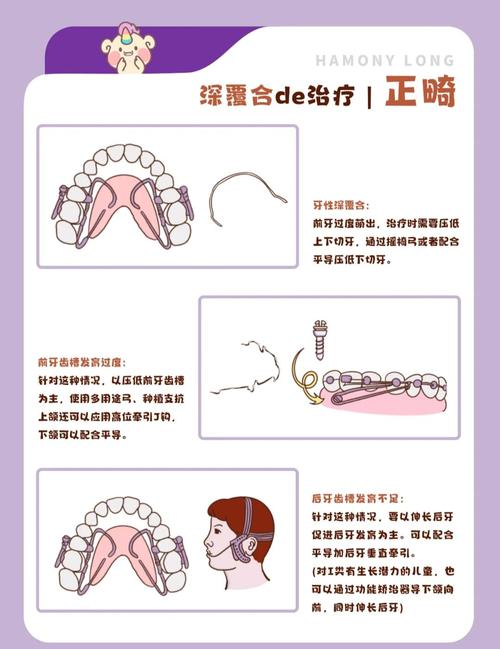 儿童深覆盖的治疗方法有哪些?不同年龄段和病因下如何选择最优矫正方案?-图2 儿童深覆盖的治疗方法有哪些?不同年龄段和病因下如何选择最优矫正方案?-图2