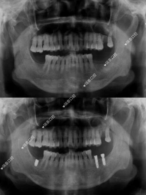种牙会影响CT检查结果准确性吗？CT成像又是否会对种牙方案制定产生干扰？-图1