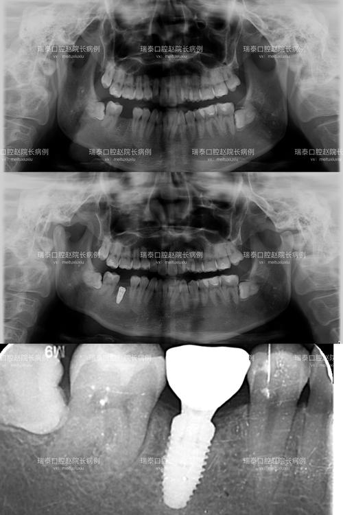 种牙会影响CT检查结果准确性吗？CT成像又是否会对种牙方案制定产生干扰？-图2