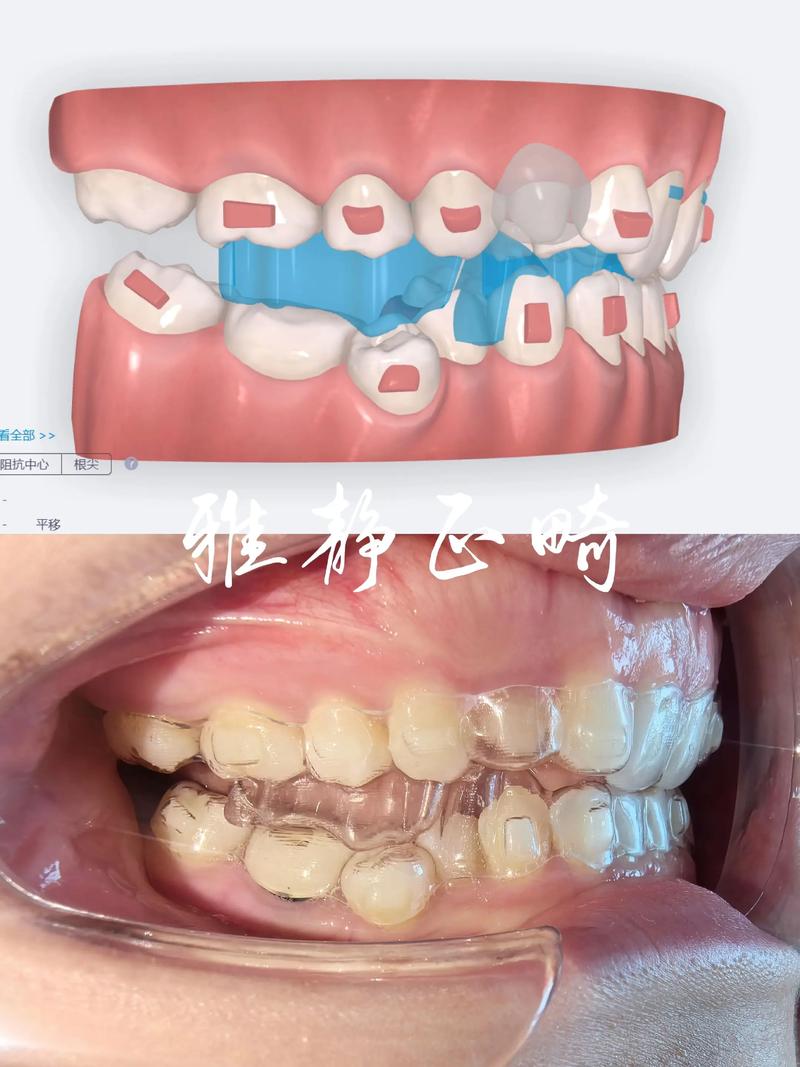 面对众多牙齿正畸隐形矫正品牌,如何挑选出效果可靠且适合自己的那一款?-图2 面对众多牙齿正畸隐形矫正品牌,如何挑选出效果可靠且适合自己的那一款?-图2
