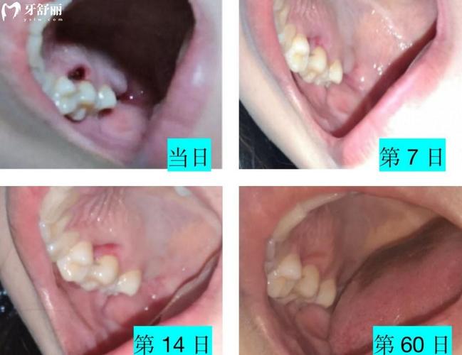 种牙后伤口愈合需要多久？不同阶段恢复时间有何差异？护理要点会影响愈合进程吗？-图1