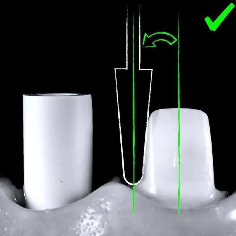 前牙预备方法视频教程中，如何根据不同牙位（中切牙/侧切牙/尖牙）调整预备形态？边缘肩台的位置与宽度如何精准把控？-图1
