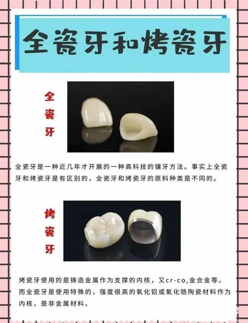镶牙、种牙、烤瓷牙三者有何本质区别？适用人群与优缺点分别是什么？-图1