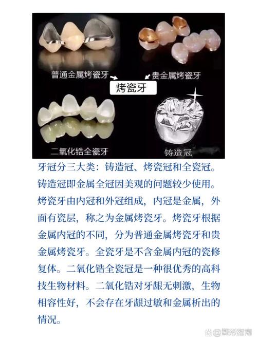 镶牙、种牙、烤瓷牙三者有何本质区别？适用人群与优缺点分别是什么？-图2