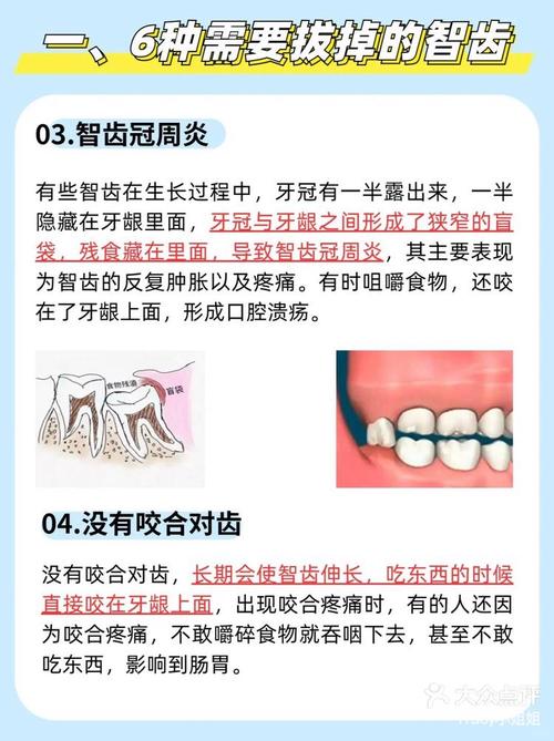 智齿的位置异常、阻生或反复发炎,会对种植牙的成功率及方案设计产生哪些具体影响?-图3 智齿的位置异常、阻生或反复发炎,会对种植牙的成功率及方案设计产生哪些具体影响?-图3
