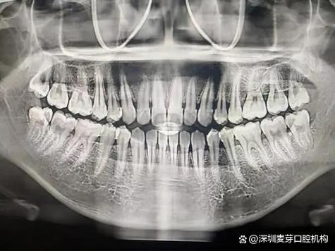 牙周炎影像检查方法有哪些？不同影像学检查手段（如X线片、CBCT等）在诊断中各有何优势和适用场景？-图2