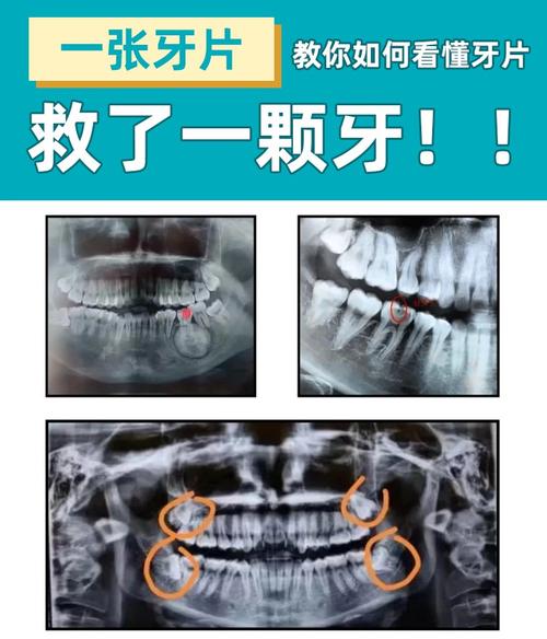 牙周炎影像检查方法有哪些？不同影像学检查手段（如X线片、CBCT等）在诊断中各有何优势和适用场景？-图1