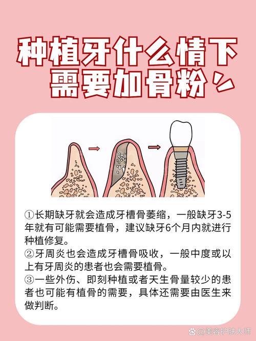 为什么种植牙时医生会建议使用骨粉?其背后的原因和必要性究竟是什么?-图1 为什么种植牙时医生会建议使用骨粉?其背后的原因和必要性究竟是什么?-图1