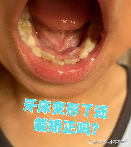 正畸后牙床倾斜为何更明显？是矫正方案设计问题还是牙槽骨适应性异常导致的？-图2