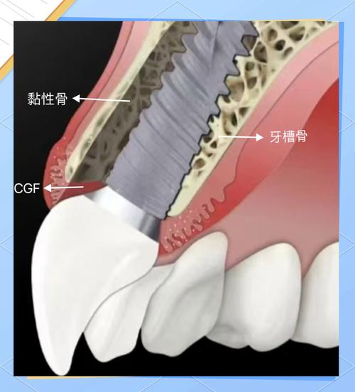 CGF临床应用方法的具体操作流程及不同适应症下的制备参数如何规范？-图2