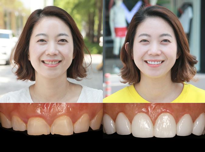 韩国种牙技术靠谱吗？材料安全有保障吗？性价比高不高？适合哪些人群做？值得选择吗？-图3