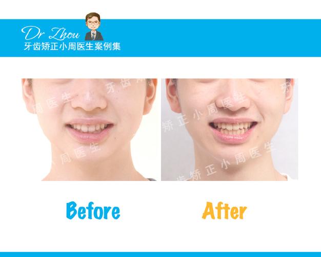 正畸打开咬合方面，这本书会详细解析哪些技术原理与临床操作要点？-图1