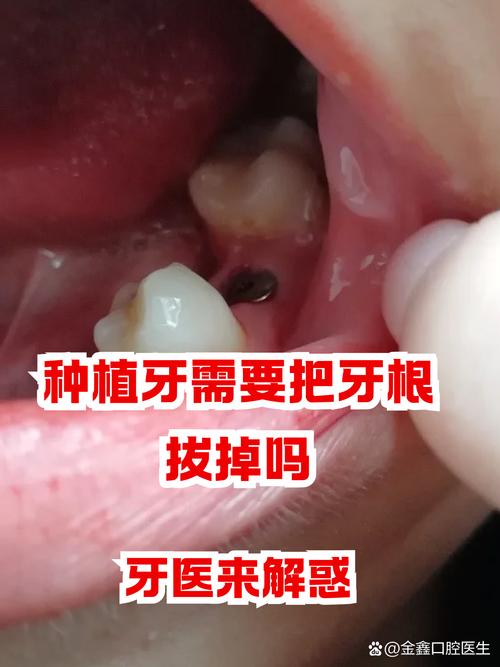 牙根拔掉后还能成功种牙吗?需要等待多久?有哪些注意事项和长期成功率?-图1 牙根拔掉后还能成功种牙吗?需要等待多久?有哪些注意事项和长期成功率?-图1