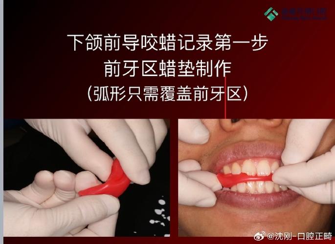 正畸打开深覆合有哪些常用方法？不同方法的适应症和治疗效果如何评估？-图3