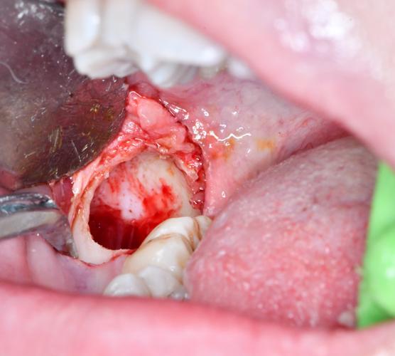 舌向阻生牙拔除方法有哪些?不同拔除技术的适应症、操作难点及临床效果如何评估?-图2 舌向阻生牙拔除方法有哪些?不同拔除技术的适应症、操作难点及临床效果如何评估?-图2