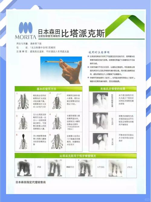 Vitapex方法在复杂根管治疗中的有效性如何?其适用范围与潜在并发症有哪些?-图1 Vitapex方法在复杂根管治疗中的有效性如何?其适用范围与潜在并发症有哪些?-图1