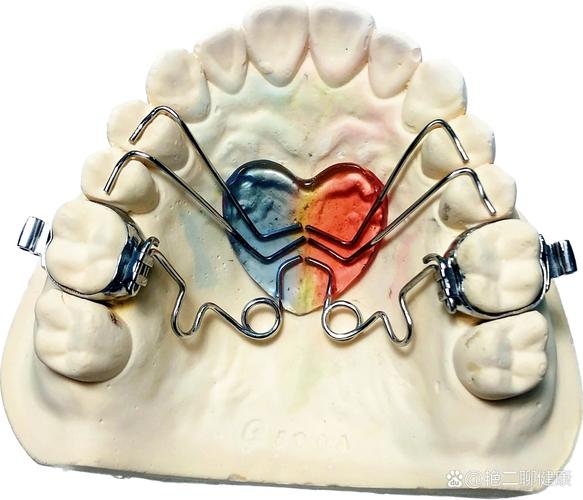 山东正畸领域周茂强钟摆矫治技术的核心原理是什么,适用于哪些错颌畸形病例的精准治疗?-图1 山东正畸领域周茂强钟摆矫治技术的核心原理是什么,适用于哪些错颌畸形病例的精准治疗?-图1