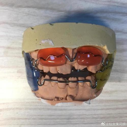 山东正畸领域周茂强钟摆矫治技术的核心原理是什么，适用于哪些错颌畸形病例的精准治疗？-图2