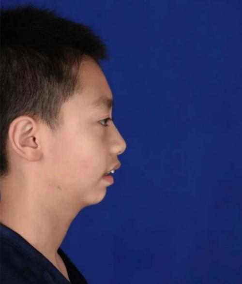 山东正畸领域周茂强钟摆矫治技术的核心原理是什么，适用于哪些错颌畸形病例的精准治疗？-图3